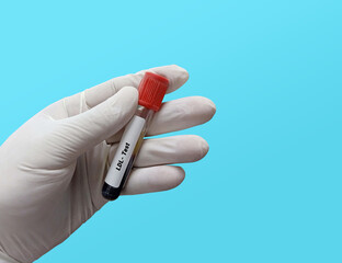 Blood sample for LDL (low-density lipoprotein) test. Lipid profile. Bad Cholesterol Medical testing concept in the laboratory background.