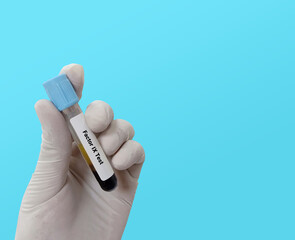 Biochemist or Lab Technologist holds Blood sample for  Factor IX. Blood coagulation testing....