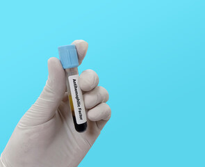 Biochemist or Lab Technologist holds Blood sample for Anti-hemophilic factor or factor viii test,...