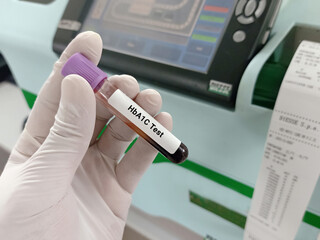 Biochemist or Lab Technologist holds Blood sample for HbA1c test (Hemoglobin A1c). Diabetic treatment monitoring in the laboratory background.