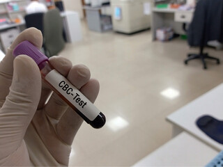 Biochemist or Lab Technologist holds Blood samples for Complete Blood Count (CBC). Blood test for...