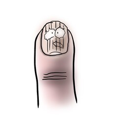 Finger and vertical nail ridges