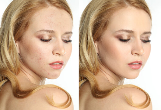 Photo before and after retouch, collage. Portrait of beautiful young woman on white background
