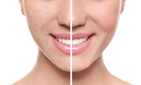Photo before and after retouch, collage. Young woman on white background, closeup