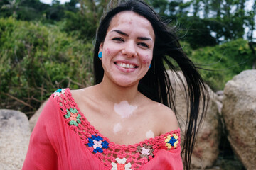 Beautiful latin girl with vitiligo on the beach. World Vitiligo Day. Pigmentation disorders. Skin...