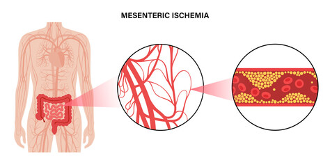 Mesentric ishemia disease