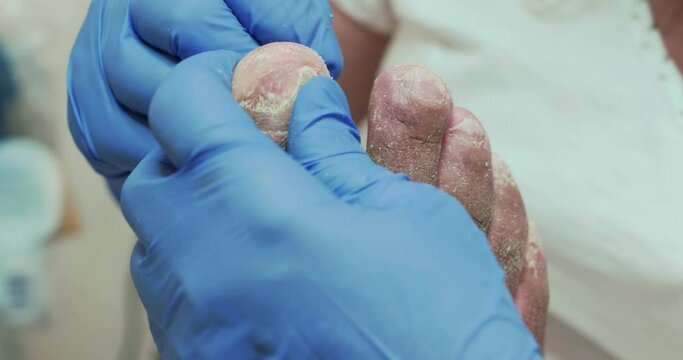 Podiatry treating fungus  damaged big toe nail of the right foot