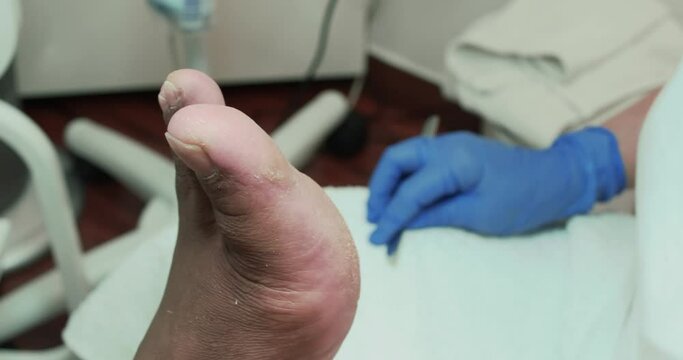 Chiropodist scrapping callus from foot sole