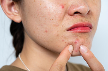 Close up of woman pointing to acne occur on her lower face. Inflamed acne consists of swelling,...