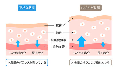 むくみと正常な肌のしくみ　断面図　ビフォアアフター