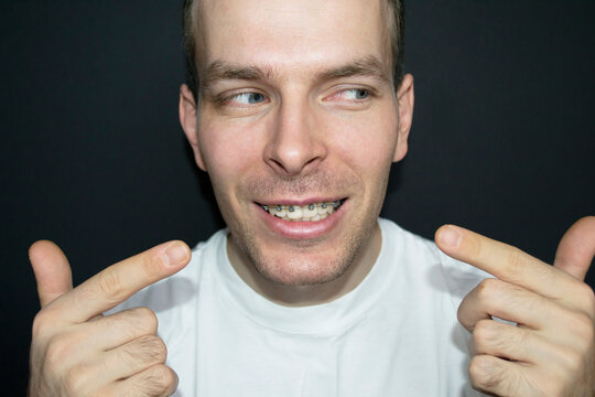Man's smile with braces on the teeth of the upper jaw