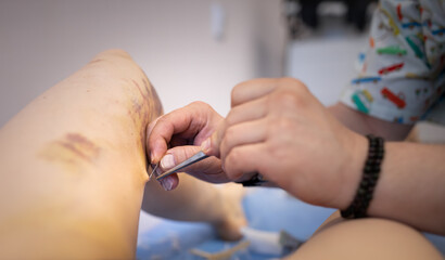 Obscured doctor removing stitch from woman's leg after surgery on veins in clinic