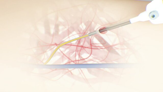 Laser surgery to remove varicose veins, laser insertion into a vein, cauterization of a vein, leg veins, human anatomy, 3D illustration