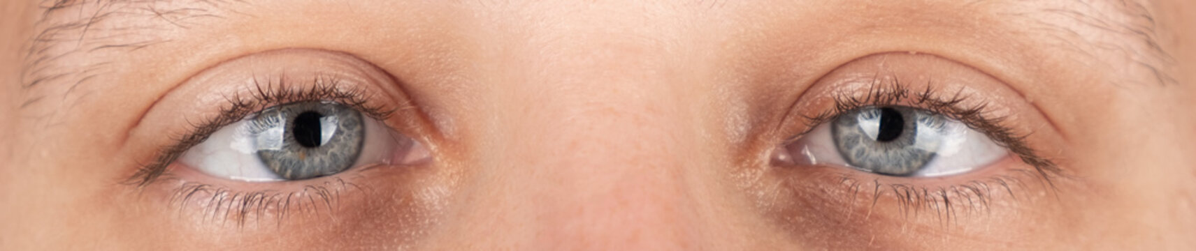 eyes of a woman suffering from strabismus close-up, eye disease, asymmetrical position of the corneas, hypertropia