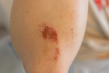 Abrasion on the woman's knee. Injured leg with a red wound. Medical treatment for first aid.