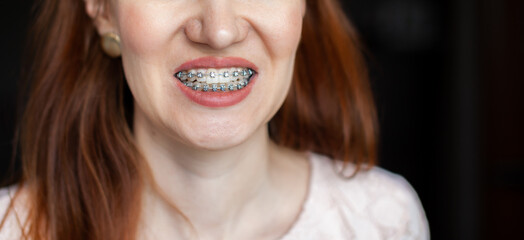 The smile of a young and beautiful girl with braces on her white teeth. Straightening of crooked...