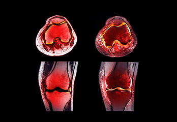 Magnetic resonance imaging or MRI  knee joint  comparison coronal and sagittal view for detect tear or sprain of the anterior cruciate  ligament (ACL)