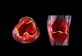 Magnetic resonance imaging or MRI  knee joint  comparison coronal and sagittal view for detect tear...