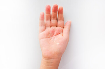 children's hand peeling