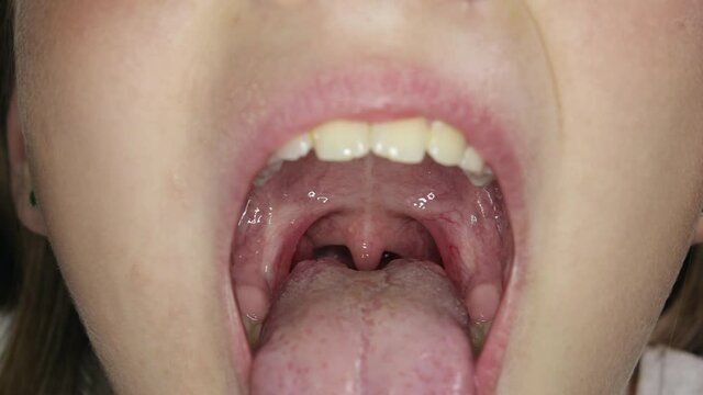Girl of 9-10 years old at an appointment with a jaw surgeon or dentist. Child with his mouth wide open and his tongue hanging out. Extreme close-up