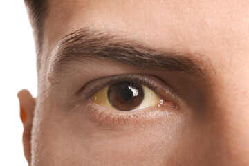 Man with yellow eyes on white background, closeup. Liver problems symptom