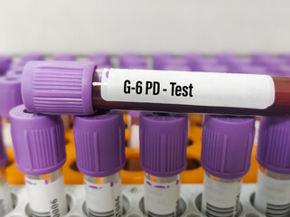 Blood sample for G6PD(glucose-6-phosphate dehydrogenase) test, helps red blood cells (RBCs)...