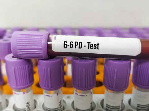 Blood sample for G6PD(glucose-6-phosphate dehydrogenase) test, helps red blood cells (RBCs) function normally, inherited disorder