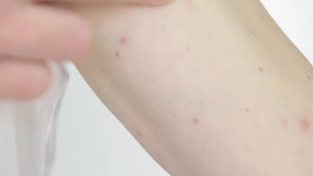 Body of adult  man have spotted, red pimple and bubble rash from chickenpox or varicella zoster virus