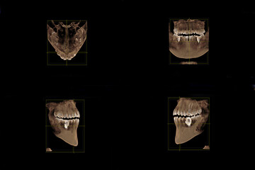 CT scan of the jaw with dental pin and missing tooth in  four planes