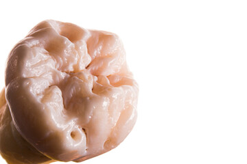 Third molar with a extrange morphology