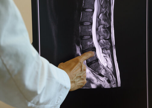 Doctor Pointing At Lumbar Spine MRI