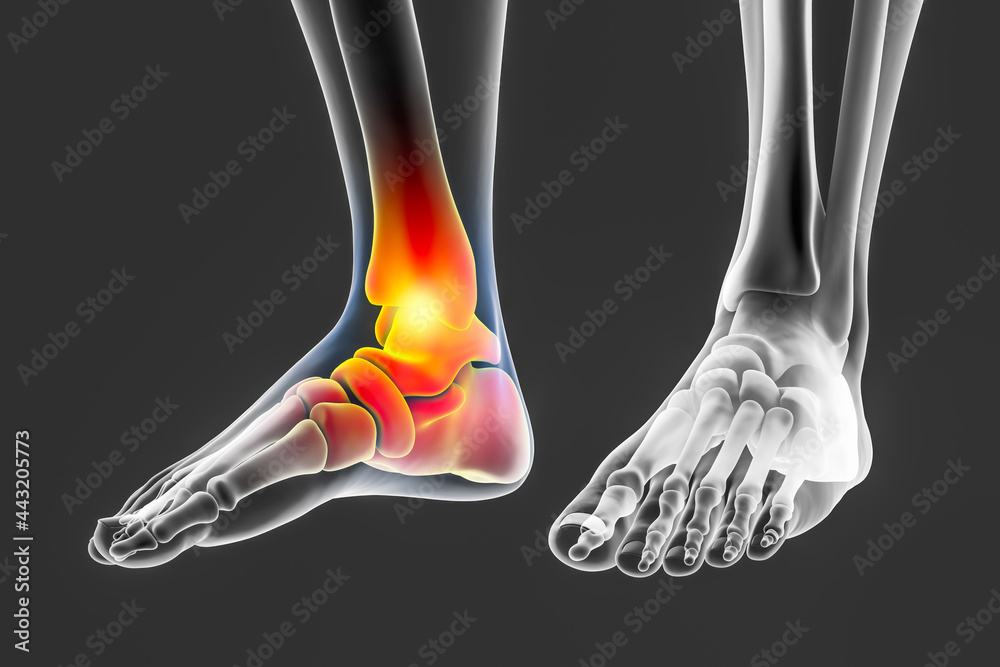 Sticker Foot and ankle pain, conceptual 3D illustration