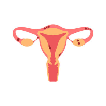 Uterus with endometriosis flat illustration. Fertility, human anatomy, female reproductive system. Disease, gynecology, inflammation.
Outside tissue growth medical condition 