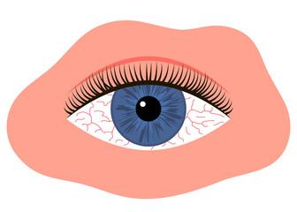Inflamed eye with red veins. Eye fatigue or allergic conjunctivitis infection. Vector illustration