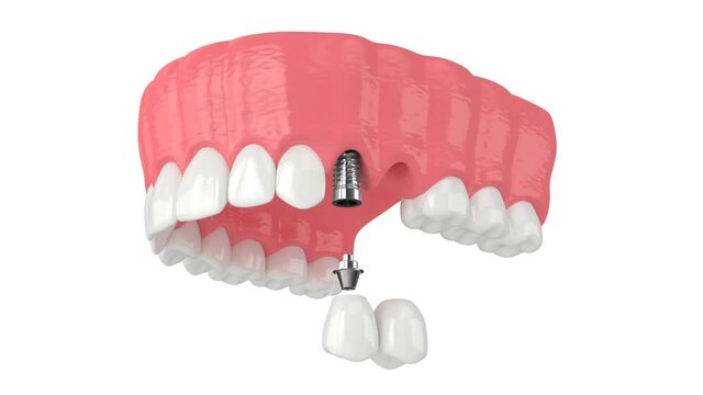 Upper jaw with implant supported dental cantilever bridge isolated over white background
