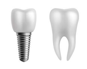 Dental implant and teeth. Realistic orthodontic elements. Human white enamel tooth crown, dentistry implantation technology, stomatology clinic object, vector 3d isolated illustration