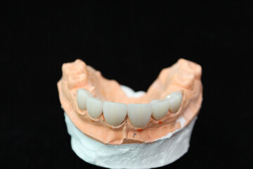 Dental crowns and veneers in the plaster model