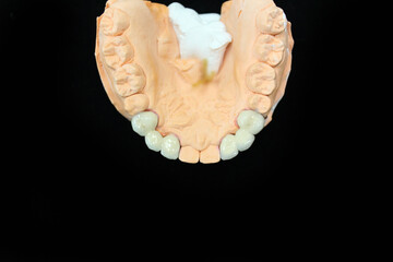 Dental crowns and veneers in the plaster model