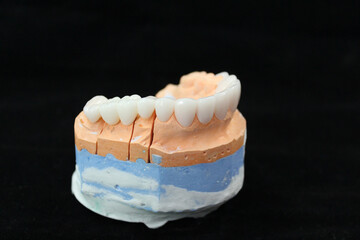 Dental crowns and veneers in the plaster model