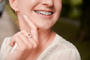 Close up of woman with orthodontic brackets on teeth touching chin and smiling. Patient...