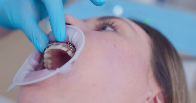 Close-up female patient face with optragate and bracket system on teeth, orthodontist hand is putting by using dental scissors a green elastic on metal braces with the multiloop archwire.