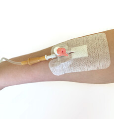  Image of a hand with a catheter. Texture background catheter in a vein in a patient. A shot of...