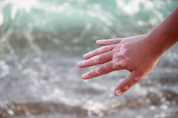Vitiligo on the hand on the sea background.