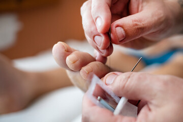 Traditional Chinese Medical Acupuncture Treatment