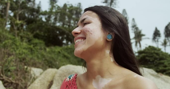 Beautiful latin girl with vitiligo on the beach. World Vitiligo Day. Pigmentation disorders. Skin depigmentation. Chronic skin disease. 4K.