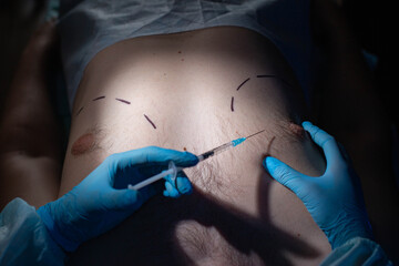 Doctor plastic surgeon with a syringe to correct the adipose tissue of the male breast. Reduction...