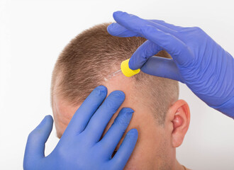 Healing oil for scalp hair restoration. Hair follicle restoration, close-up. Dihydrotestosterone