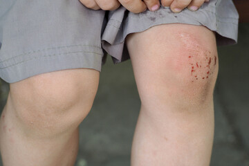the child has a wound on his knee after a fall . baby's feet