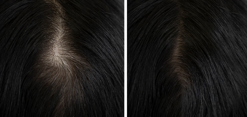 woman head hair baldness before and after treatment - obrazy, fototapety, plakaty