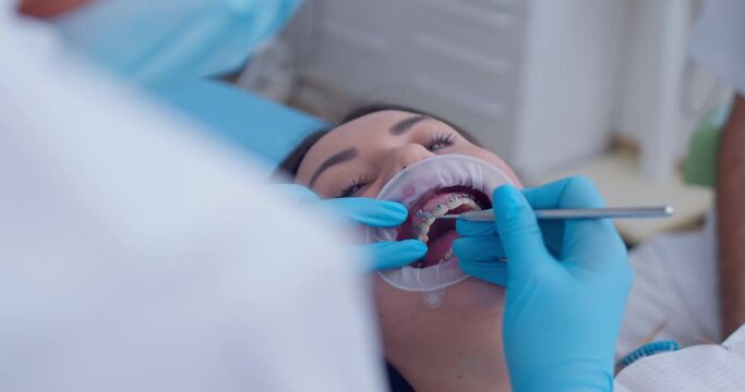 The close-up open mouth of a female patient with optragate and on the teeth is a bracket system, the medical hand is taking out details from the upper jaw with the braces by using a dental probe.